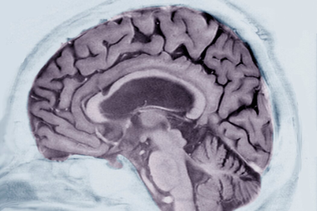 阿尔茨海默病患者的核磁共振扫描.jpg
